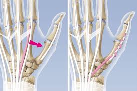 Hamstring endurance was an average of 81% and 91% of the nonoperative limb at 240. Epl Ruptur Riss Der Langen Daumenstrecksehne Ksw