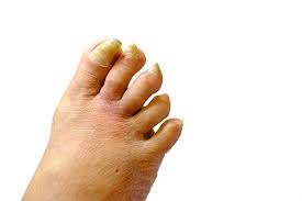 Image result for Onychogryphosis feet