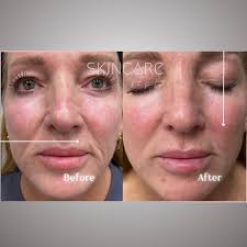 Results after ONE Co2 laser treatment