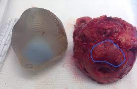 However, as with other types of cancer,. Surgeon Uses 3d Model Of Patient S Prostate To Restore Sense Of Touch To Robotic Surgery