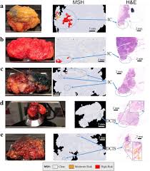 They're often easy to move around (mobile) and may be tender. Intra Operative Spectroscopic Assessment Of Surgical Margins During Breast Conserving Surgery Breast Cancer Research Full Text
