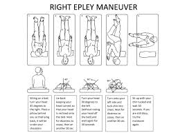 The epley maneuver is an exercise performed to treat a type of vertigo called benign paroxysmal positional vertigo. Bppv Resources Vestibular Today