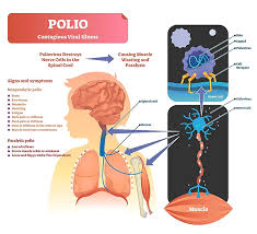 English For Nursing All About Poliomyelitis