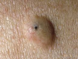 Epidermoid Cyst Dermnet Nz