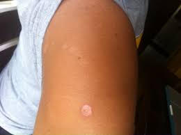 You can help reduce your risk of cancer by making healthy choices like eating right, staying active and not smoking. I Blame Myself For Getting Skin Cancer