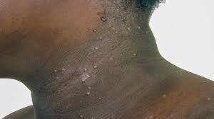 Molluscum Contagiosum: Causes, Symptoms, Treatment, and Pictures