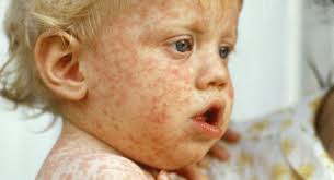 Immunization is the best way to prevent measles and is very effective in  preventing disease. Learn about measles immunizations:  https://www.healthlinkbc.ca/healthlinkbc-files/measles-mumps-rubella-mmr-vaccine  Stay safe and keep others safe from measles ...