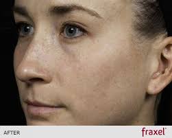 Solta medical is a global leader in the aesthetic industry providing innovative products such as vaserlipo®, vaser® ultrasonic systems, thermage® radiofrequency . Fractional Laser Fraxel Ribe Clinic