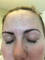 I got my Eyebrows done at the salon 2 days ago and woke up to this big Red  Spot Across my hair's I don't know what to do… ☹️