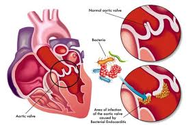 The diagnosis of acute myocarditis is usually presumptive, based on. Endocarditis Disease With Causes And Nursing Intervention