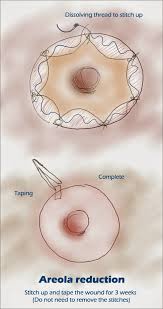 How long does areola reduction surgery last? Areola Reduction Breast Surgery Korea Kies U Breast Augmentation Korea Plastic Surgery Kies U