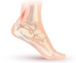 How to heal achilles tendon faster. 5 Reasons Your Achilles Tendon Exercises Are Failing