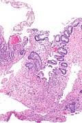 Image result for Radiation Colitis