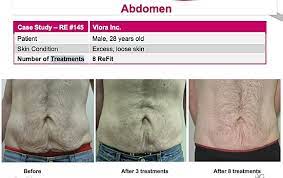 Must complete the entire course. Body Contouring And Cellulite Reduction Laser Training Courses