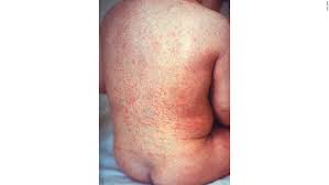 Information on hantaviruses, hantavirus pulmonary syndrome (hps), and hemorrhagic fever with renal syndrome (hfrs). Hantavirus Hantavirus Rash