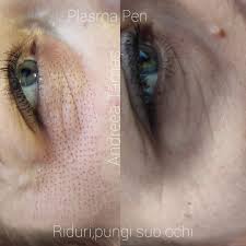 Este indicat să tre prezinți la medic încă de la. Cicatrici Lifting Plasma Hyaluron Pen By Andreea Facebook