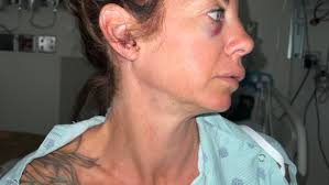 Fundraiser by Ashly Guardino : Recovery from a violent assault in murrieta