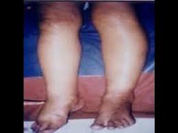 Thiamine is needed to break down food such as glucose. Beriberi Youtube