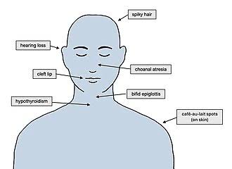 Bamforth–Lazarus syndrome - Wikipedia