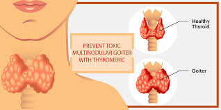 It is one of the most common forms of hyperthyroidism. Study Proves Curcumin Can Help In Toxic Multinodular Goiter