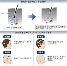 突然現れて驚く円形脱毛症 免疫異常が原因 ヘルスｕｐ nikkei style 自己免疫疾患 アレルギー 薬 ヘルス