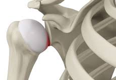 Image result for Shoulder Subluxation