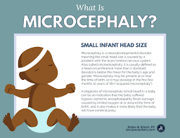 Microcephaly Birth Injuries Such As Cerebral Palsy