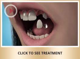 Maybe you would like to learn more about one of these? Replace Missing Teeth Liverpool Liverpool Smile Studio