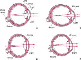 overview of refractive error eye disorders msd manual