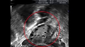 Antral Follicle Counts In Real Time Youtube