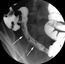 The response to therapy in crohn's disease (cd) depends on the inflammatory or fibrostenotic nature of the underlying pathological process. The Smaller Bowel Imaging The Small Bowel In Paediatric Crohn S Disease Postgraduate Medical Journal