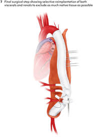 EACTSSTS Guidelines for Diagnosing and Treating Acute and Chronic  Syndromes of the Aortic Organ - The Annals of Thoracic Surgery