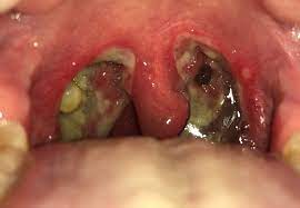 Maybe you would like to learn more about one of these? Picture Taken Of My Throat After My Tonsillectomy In December Medicalgore