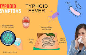Image result for Typhoid Fever