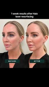 Swelling After Face Laser