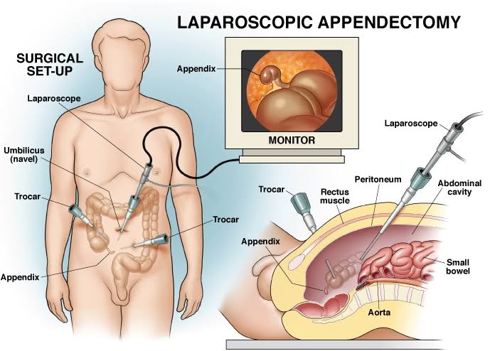 Laparoscopic Appendicectomy product image