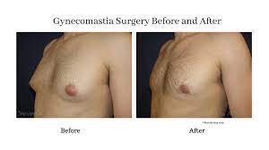 Find top brand hockey sticks at an affordable price online. How Can Men Conceal Gynecomastia Surgical Scars