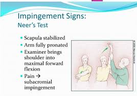 Image result for Neer Test