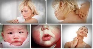 On my forehead and cheeks i have small bumps that are red and they really stand out. 10 Ways To Get Rid Of Eczema Fast And Naturally Howhunter
