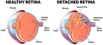 This is called posterior vitreous detachment (pvd). Retinal Tear Detachment Treatment Wolfe Eye Clinic