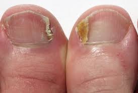 Na maior parte dos casos de onicomicose atinge unhas placa em pé, por isso a doença é visto de uma vez, mas já na fase expressas sintomas. Mitos E Verdades Sobre A Micose
