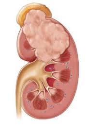 Nonsurgical Procedure For Destroying Cancerous Renal Tumours Outperforms Surgery