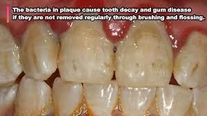 This will usually include some of the other common sights from the dentist's office. Youtube S Best Plaque Removal Scraping Diy Teeth Whitening Youtube
