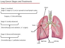 Medical Surgical Nursing Cancer Stages Medical Surgical Nursing Chemotherapy