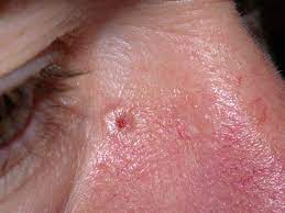 In fact, 1 out of 5 americans will likely develop skin cancer in their lifetimes. What Is This White Bump On My Face