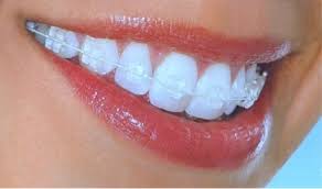 How long does an average invisalign case take to work? The Difference Between Clear Braces And Invisalign Treatment