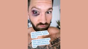 Dc young fly, fetty wap. Nach Boxkampf Im Live Tv Oliver Sanne Zeigt Sein Blaues Angeschwollenes Auge