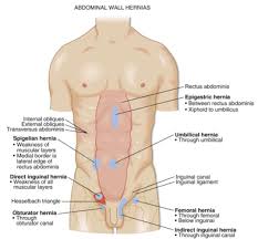 The most common types of hernia are inguinal. Inguinal Hernia Imaging And Reduction Nuem Blog
