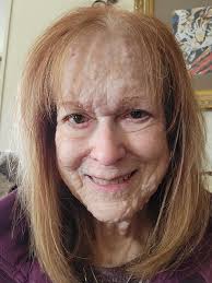 Hi nf family.. Is that safe for us to take vit. E?🤔 what vitamin. you guys  take? I take vit. E but i notice that my bumps getting obvious now what i