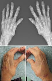 母 指 cm 関節 症 手術 後 リハビリ